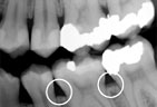 Periodontitis