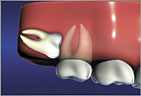 Horizontal Impaction always requires extraction Wisdom Teeth Horizontal Impaction