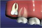 Vertical Impaction often requires extraction Wisdom Teeth Vertical Impaction