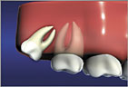 Distal Impaction is angled back Wisdom Teeth Distal Impaction